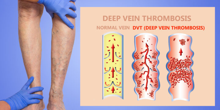 Comprehensive Treatment Options for Deep Vein Thrombosis (DVT)