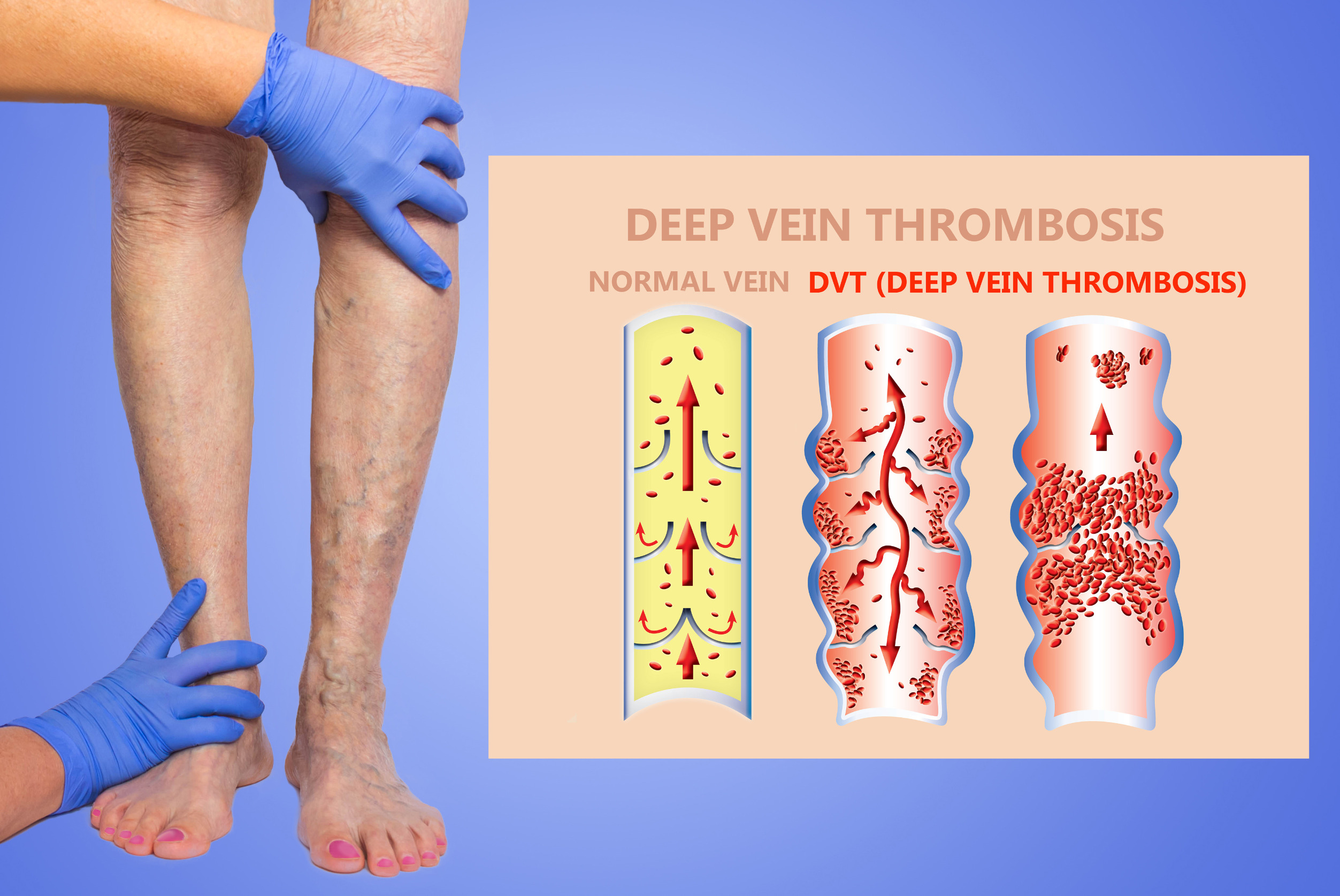 DVT treatment Washington
