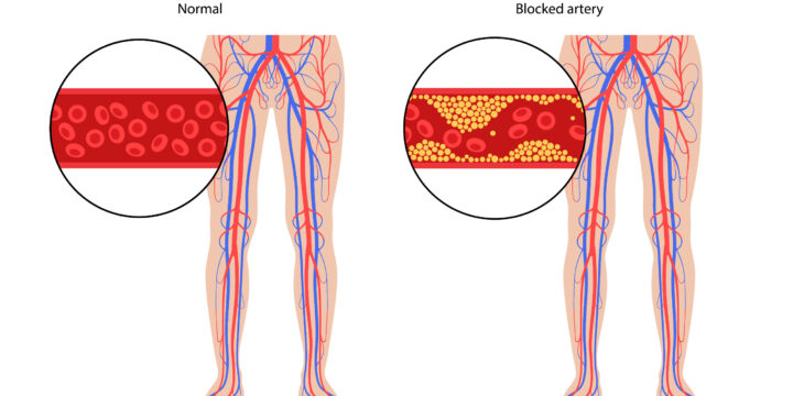 Interventional Radiology Offerings for Peripheral Artery Disease at Davis Vein and Vascular in Houston