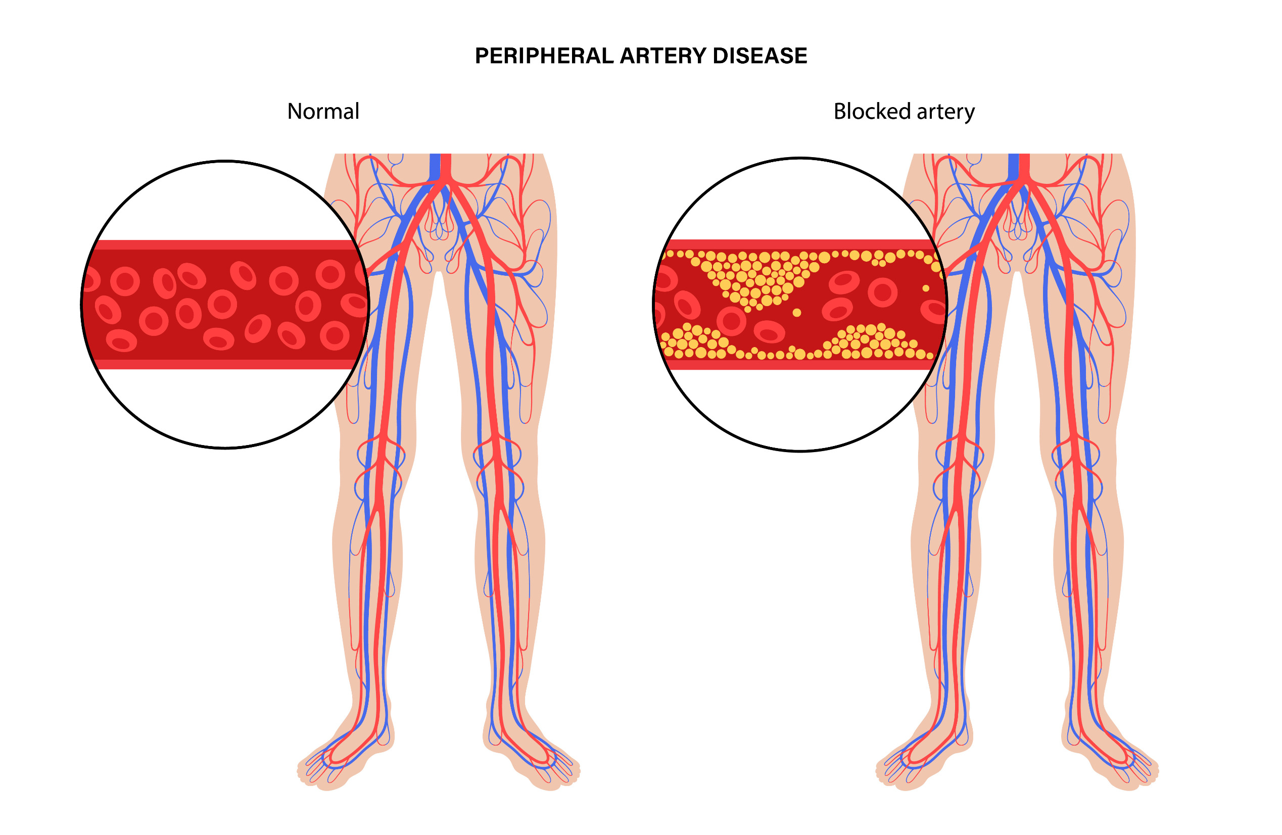peripheral artery disease treatment Houston